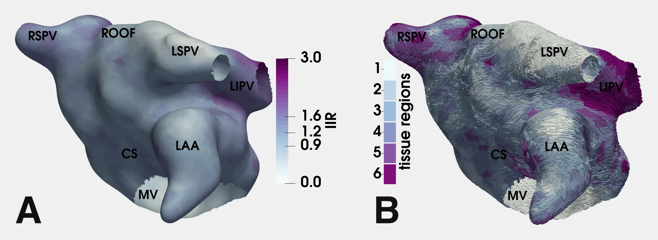 A left atrium with the image intensity ratio from MRI (A), and the six tissue types defined from it (B). Panels A and B of Figure 1 of Corrado et al. (2025), Communications Medicine, under CC BY 4.0.