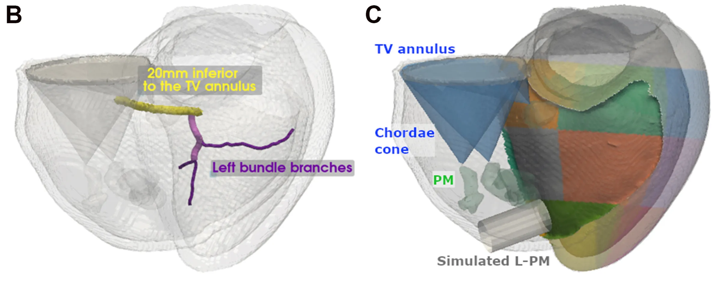 A biventricular mesh built from cardiac CT, with the tricuspid valve apparatus, the papillary muscles and an estimate of the left bundle branches (B), and with the American Heart Association regions mapped onto the left ventricular epicardium and the right ventricular septum, across which a leadless pacemaker is virtually implanted (C). Panels B and C of Figure 1 of Lee et al. (2026), Heart Rhythm O2, under CC BY 4.0.